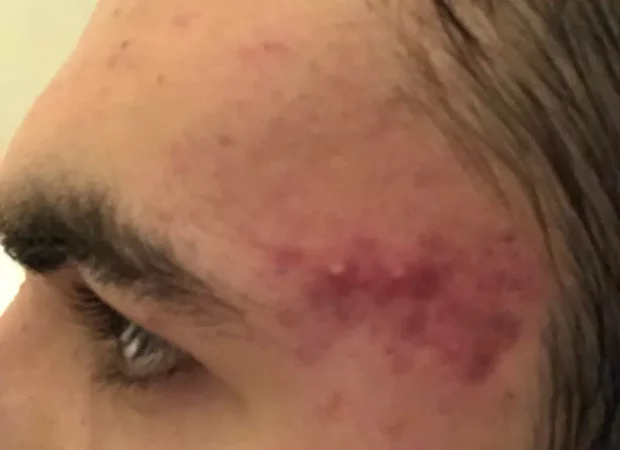 ACNE en la si&eacute;n