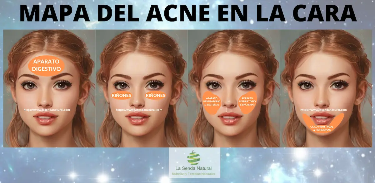 Mapa del acné 19 Mapa del acné