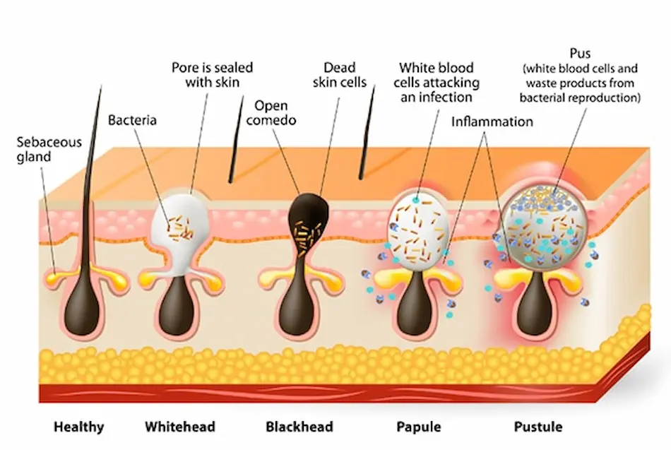 Tipos de acn&eacute;