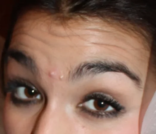 acn&eacute; entre las cejas