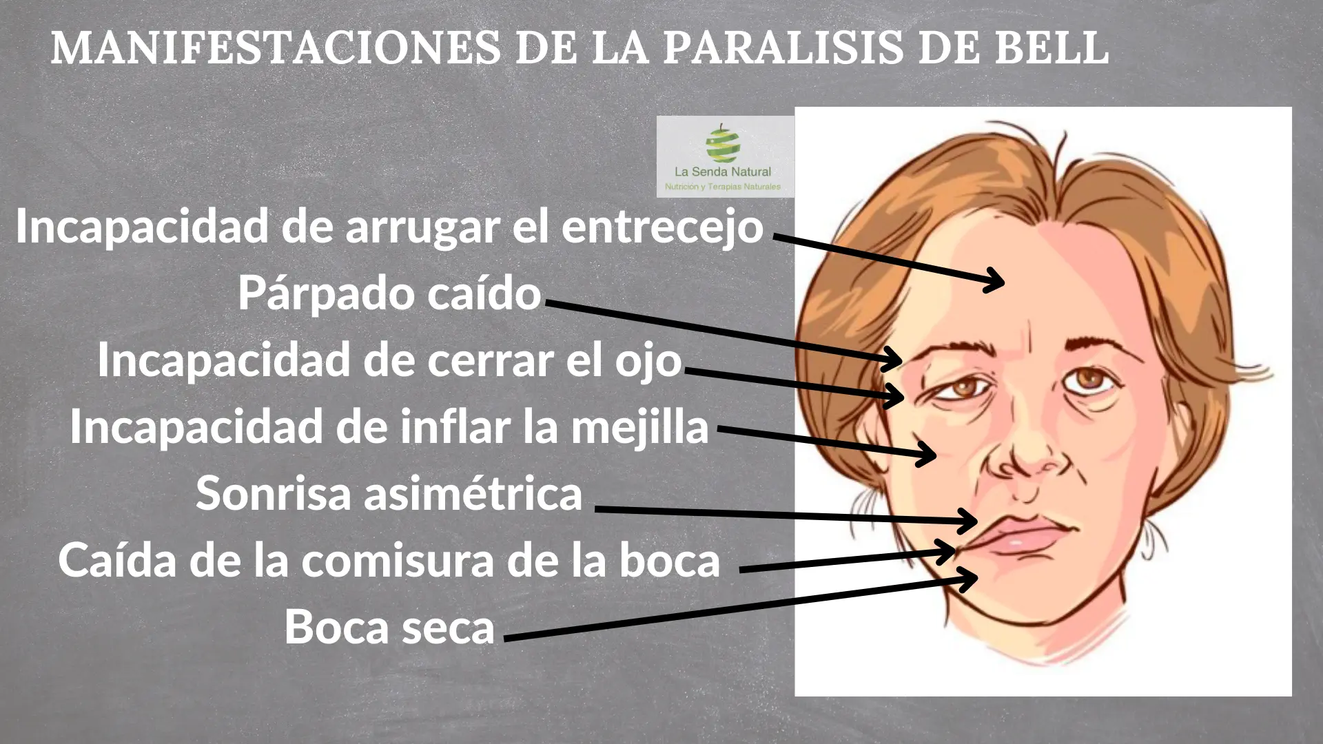 Signos de la par&aacute;lisis de Bell