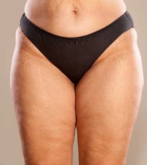 Sal Nº12 Calcárea Sulfúrica 4 calcium sulphuricum y celulitis