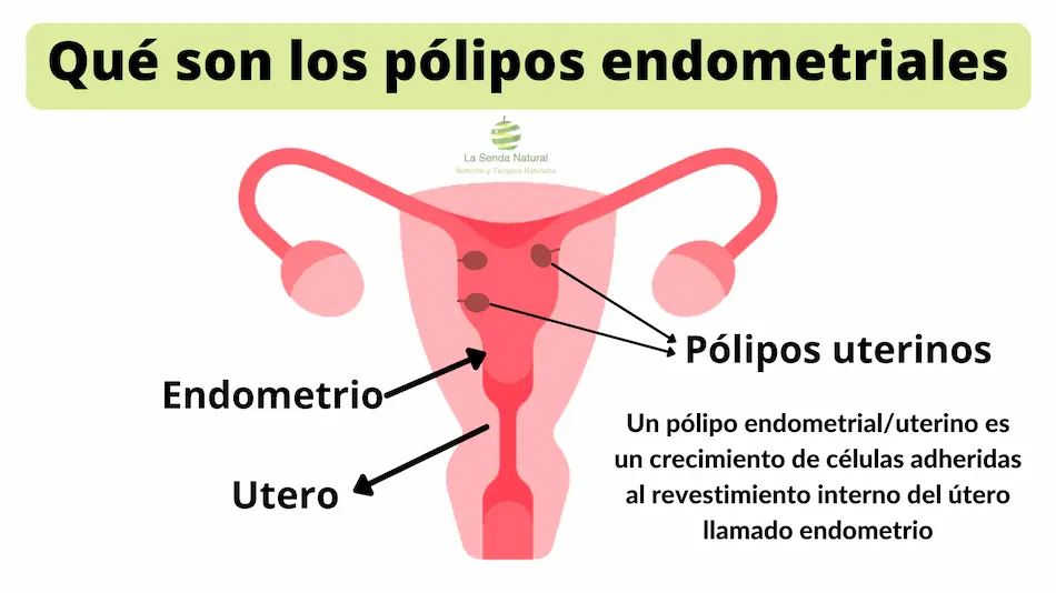 Que son los p&oacute;lipos vaginales